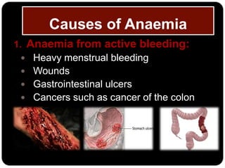 Causes of Anaemia
1. Anaemia from active bleeding:
   Heavy menstrual bleeding
   Wounds
   Gastrointestinal ulcers
   Cancers such as cancer of the colon
 