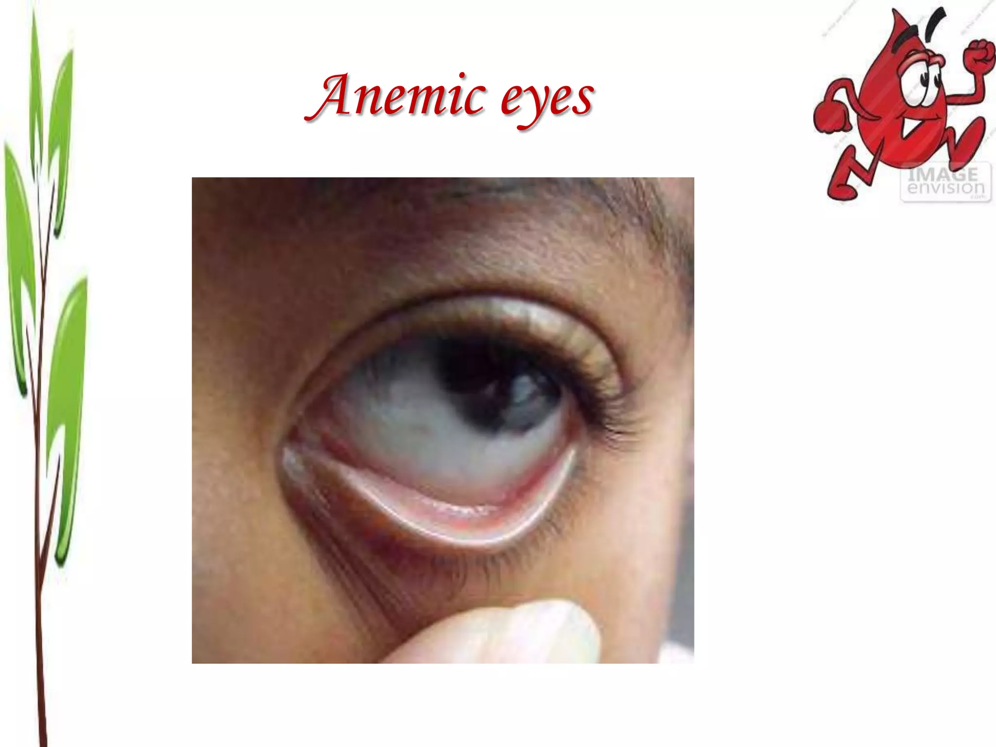 Anaemia | PPTX