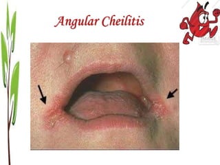 Angular Cheilitis
 