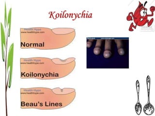 Koilonychia
 