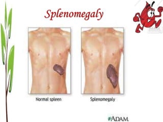 Splenomegaly
 