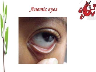 Anemic eyes
 