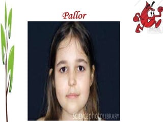 Pallor
 