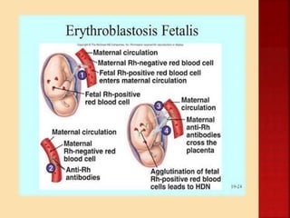 Anaemia- Classification, types, causes, pathophysiology, etiology