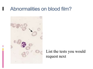 Abnormalities on blood film?
List the tests you would
request next
 