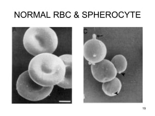 Spirocyte Rbc Anaemia, Polycythemia - Blood- Physiology | PPT