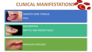 SMOOTH SORE TONGUE
PICA
KOILONYCHIA
BRITTLE AND RIDGED NAILS
ANGULAR CHEILOSIS
 