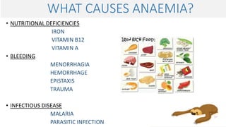 WHAT CAUSES ANAEMIA?
• NUTRITIONAL DEFICIENCIES
IRON
VITAMIN B12
VITAMIN A
• BLEEDING
MENORRHAGIA
HEMORRHAGE
EPISTAXIS
TRAUMA
• INFECTIOUS DISEASE
MALARIA
PARASITIC INFECTION
 