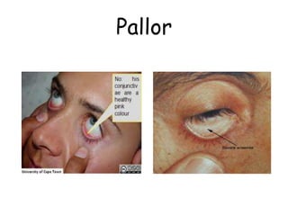 Pallor
 