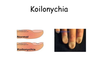 Koilonychia
 