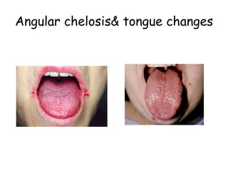 Angular chelosis& tongue changes
 