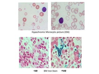 Hypochromic Microcytic picture (IDA)
-ve BM Iron Stain +ve
 