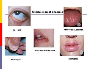 Anaemia in pregnancy | PPT