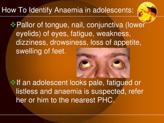 How To Identify Anaemia in adolescents: 
Pallor of tongue, nail, conjunctiva (lower 
eyelids) of eyes, fatigue, weakness, 
dizziness, drowsiness, loss of appetite, 
swelling of feet. 
If an adolescent looks pale, fatigued or 
listless and anaemia is suspected, refer 
her or him to the nearest PHC. 
 