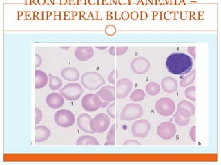IRON DEFICIENCY ANEMIA –
PERIPHEPRAL BLOOD PICTURE
 