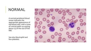 NORMAL
A normal peripheral blood
smear indicates the
appropriate appearance of
red blood cells, with a zone
of central pallor occupying
about 1/3 of the size of the
RBC
See also Neutrophil and
few platelets
 