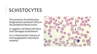 SCHISTOCYTES
The presence of schistocytes
(fragmented red blood cells) on
the peripheral blood smear.
It suggests red blood cell injury
from damaged endothelium
It is a characteristic feature of
microangiopathic haemolytic
anaemia.
 