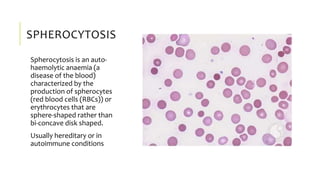 SPHEROCYTOSIS
Spherocytosis is an auto-
haemolytic anaemia (a
disease of the blood)
characterized by the
production of spherocytes
(red blood cells (RBCs)) or
erythrocytes that are
sphere-shaped rather than
bi-concave disk shaped.
Usually hereditary or in
autoimmune conditions
 