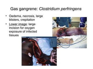 Gas gangrene: Clostridium perfringens
• Oedema, necrosis, large
blisters, crepitation
• Lower image: large
incision for oxygen
exposure of infected
tissues
 