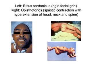 Left: Risus sardonicus (rigid facial grin)
Right: Opisthotonos (spastic contraction with
hyperextension of head, neck and spine)
 
