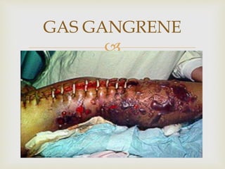 
GAS GANGRENE
 