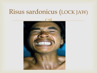 
Risus sardonicus (LOCK JAW)
 