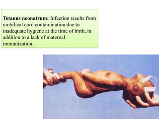 Tetanus neonatrum: Infection results from
umbilical cord contamination due to
inadequate hygiene at the time of birth, in
addition to a lack of maternal
immunization.
 