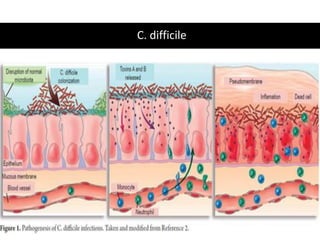 C. difficile
 