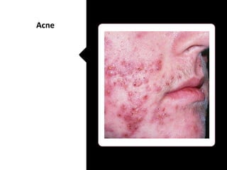 Acne
 