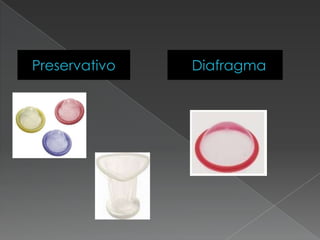 Preservativo   Diafragma
 