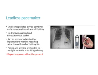 Externalized Rv Pacemaker Anaesthesia considerations for patients with implantable devices.pptx