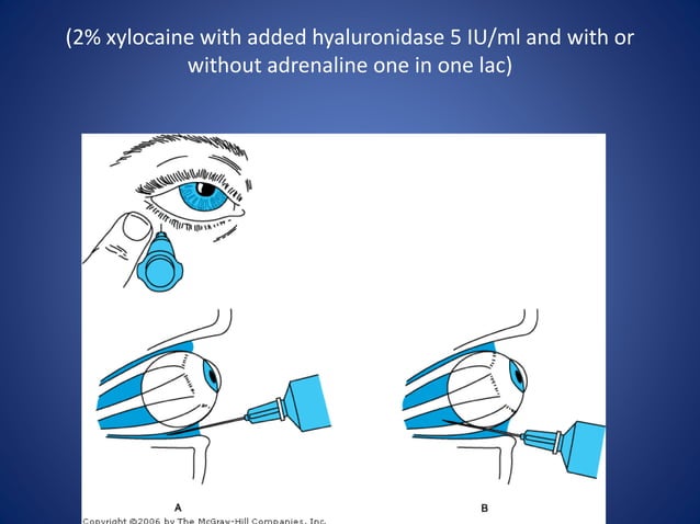 Anaesthesia for cataract surgery | PPTX
