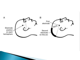 Ectr Attachment Anaesthesia for ELECTROCONVULSIVE THERAPY/ECT | PPT