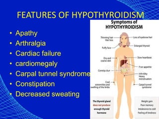 FEATURES OF HYPOTHYROIDISM
• Apathy
• Arthralgia
• Cardiac failure
• cardiomegaly
• Carpal tunnel syndrome
• Constipation
• Decreased sweating
 
