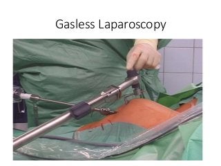 Gasless Laparoscopy
 