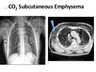 .. CO2 Subcutaneous Emphysema
 