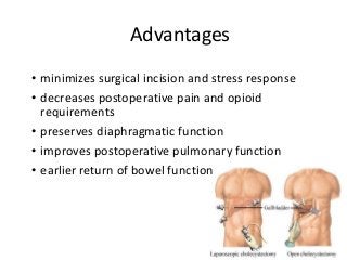 Advantages
• minimizes surgical incision and stress response
• decreases postoperative pain and opioid
requirements
• preserves diaphragmatic function
• improves postoperative pulmonary function
• earlier return of bowel function
 