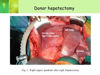 Donor hepatectomy
 