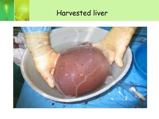 Harvested liver
 