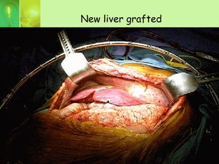 New liver grafted
 