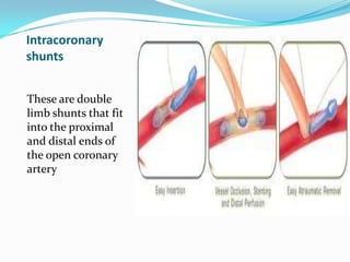 Anaesthesia for off pump coronary artery bypass grafting | PPTX