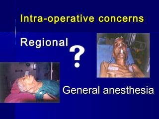 Intra-operative concerns

Regional
        
        General anesthesia
 