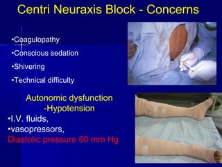 Centri Neuraxis Block - Concerns

•Coagulopathy
•Conscious sedation
•Shivering
•Technical difficulty

      Autonomic dysfunction
           -Hypotension
•I.V. fluids,
•vasopressors,
Diastolic pressure 60 mm Hg
 