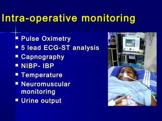 Intra-operative monitoring
     Pulse Oximetry
     5 lead ECG-ST analysis
     Capnography
     NIBP- IBP
     Temperature
     Neuromuscular
      monitoring
     Urine output
 