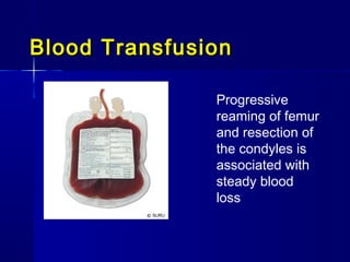 Blood Transfusion

               Progressive
               reaming of femur
               and resection of
               the condyles is
               associated with
               steady blood
               loss
 