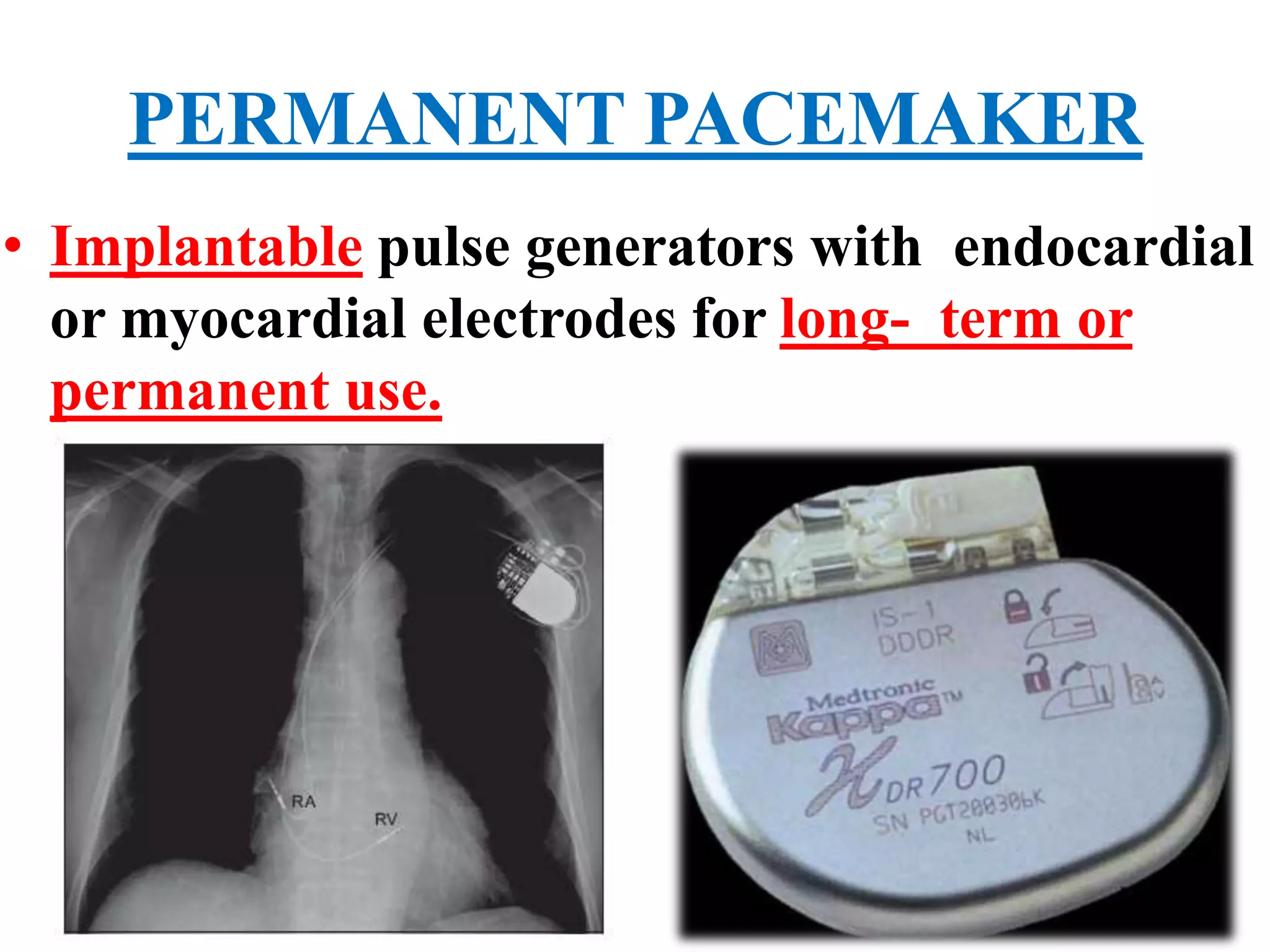 PERMANENT PACEMAKER
• Implantable pulse generators with endocardial
or myocardial electrodes for long- term or
permanent use.
 