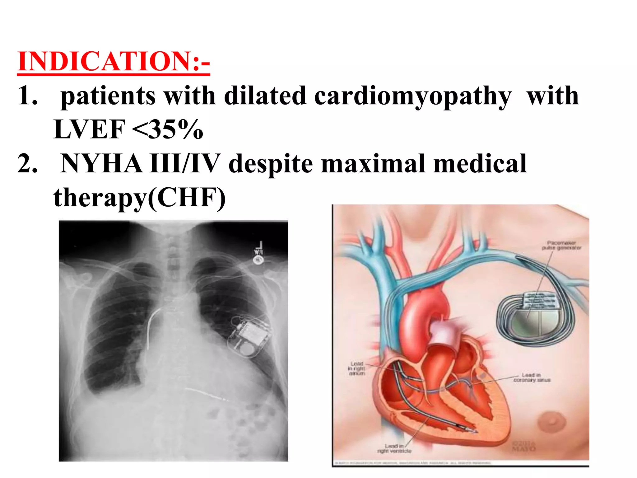 INDICATION:-
1. patients with dilated cardiomyopathy with
LVEF <35%
2. NYHA III/IV despite maximal medical
therapy(CHF)
 