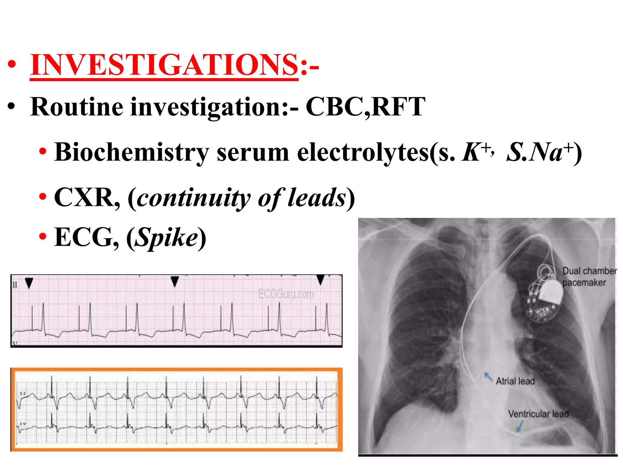 • INVESTIGATIONS:-
• Routine investigation:- CBC,RFT
• Biochemistry serum electrolytes(s. K+, S.Na+)
• CXR, (continuity of leads)
• ECG, (Spike)
 