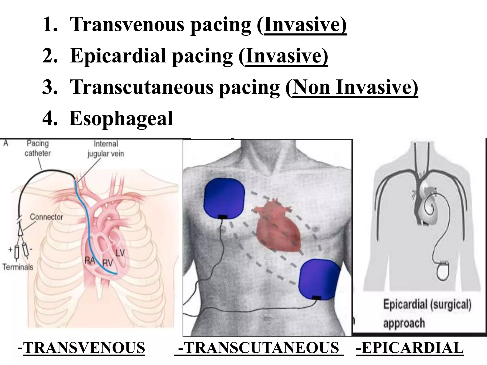 -TRANSVENOUS -TRANSCUTANEOUS -EPICARDIAL
1. Transvenous pacing (Invasive)
2. Epicardial pacing (Invasive)
3. Transcutaneous pacing (Non Invasive)
4. Esophageal
 
