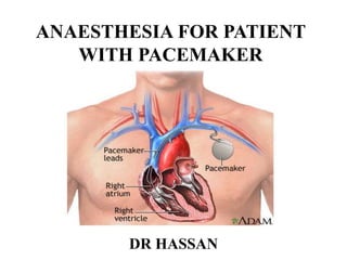 ANAESTHESIA FOR PATIENT
WITH PACEMAKER
DR HASSAN
 